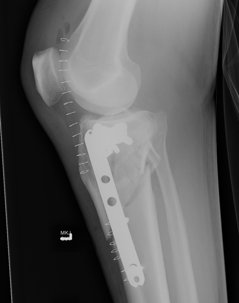 Tibial Plateau Schtazker 6 ORIF Lateral